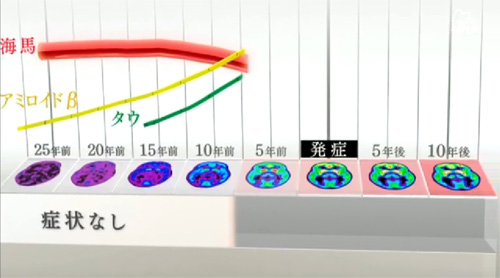認知症発症メカニズム 認知症発症メカニズム