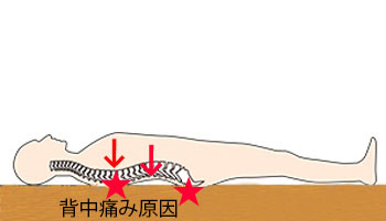 反発力が高いマットレスでは背中の凸部を圧迫し痛みとなる