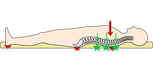 薄い布団や低反発マットに寝ると背中の凸部は圧迫されて痛みの原因となる
