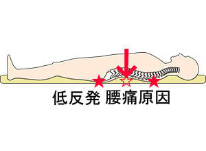 トゥルースリーパーやテンピュールマットレス腰痛原因，